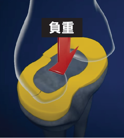 半月板撕裂